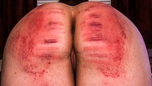 caning welts